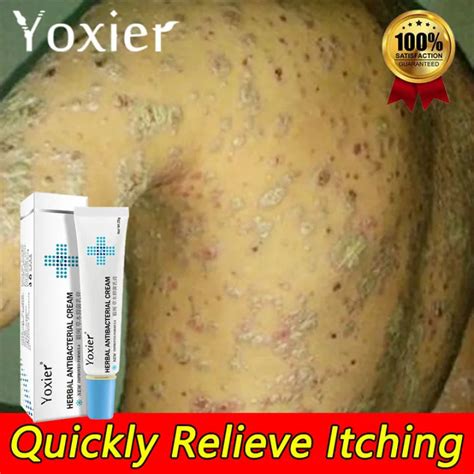 Anti Fungal Ointment Yoxier Herbal Antibacterial Cream 20g