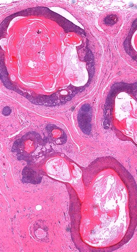 Pin On Dermatopathology Posts Articles Illustrations And Quiz Cases