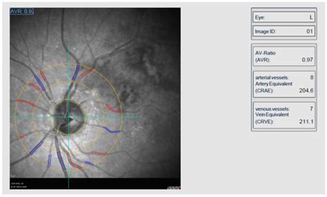 Jpm Free Full Text Alterations In Retinal Vessel Diameters In Patients With Retinal Vein