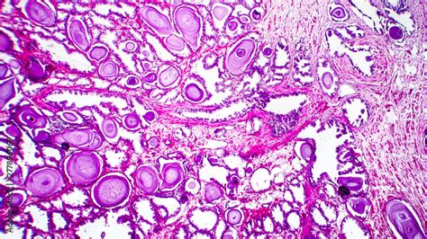 Histopathology Of Prostate Gland Hyperplasia Light Micrograph Photo