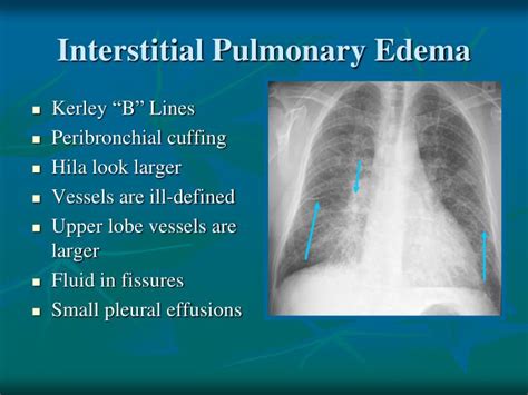 Pulmonary Edema Vs Pneumonia