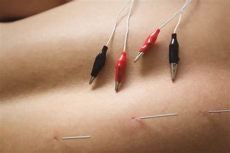 Recover Rx Dry Needling Pelvic Floor Therapy