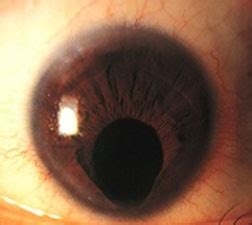 Coloboma - American Association for Pediatric Ophthalmology and Strabismus