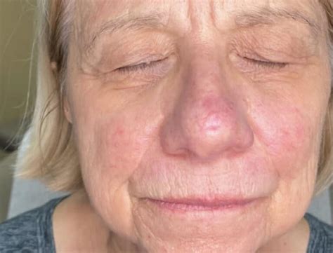 BBL Treating Rosacea Affiliated Troy Dermatologists