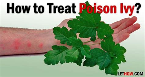 How To Get Rid Of Poison Ivy Rashes Fast With Images Poison Oak Poison Ivy Poison Ivy Rash