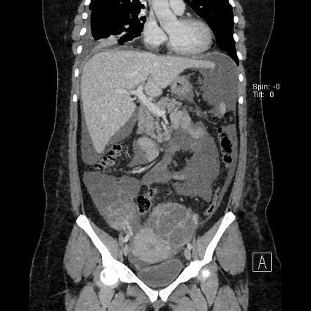 Ovarian Hyperstimulation Syndrome Image Radiopaedia Org