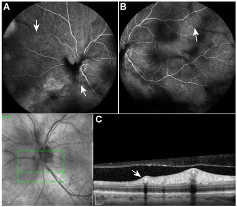 Kyrieleis Arteriolitis Associated With Acute Retinal Necrosis Due To