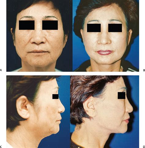 Rejuvenation Of The Aging East Asian Face Plastic Surgery Key