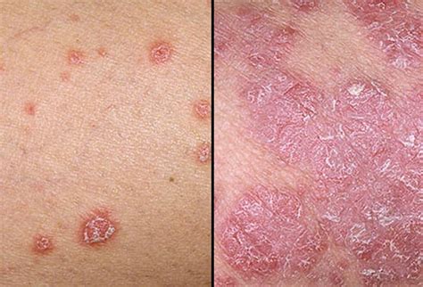 10 Common Types Of Skin Rash And Treatments