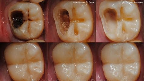 Awesome Quotes: Reverse Cavities And Heal Tooth Decay With These 4 EASY ...