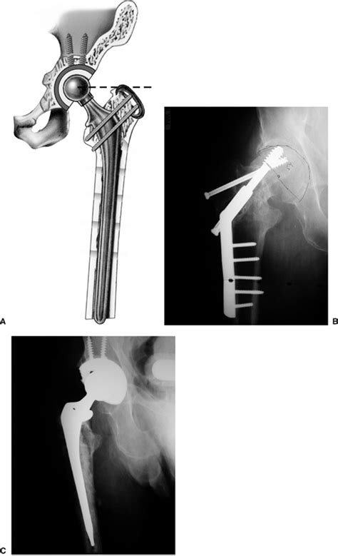 Intertrochanteric Fracture Surgery