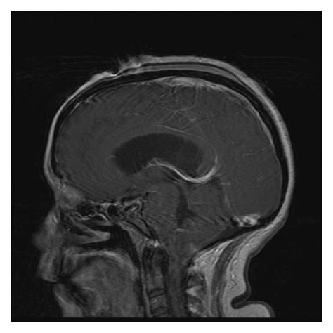 A Preoperative T Weighted Mri With Sagittal View B Postoperative