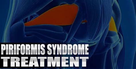 Piriformis Syndrome Treatment Chiropractor El Paso Tx Video