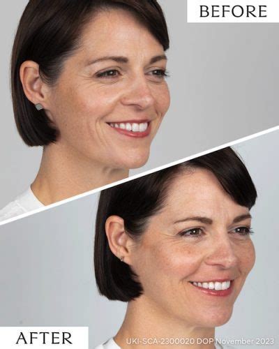 Sculptra Before And After Photos Mulberry House Clinic