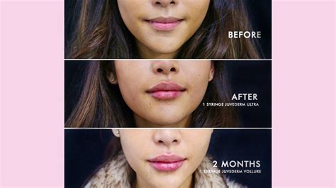 Restylane Vs Juvederm For Lips Whats The Difference Lip Injections