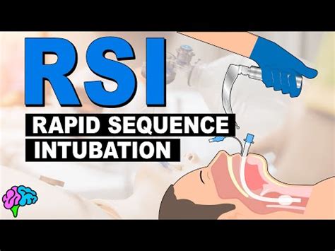 Understanding Rapid Sequence Intubation Rsi For Efficient Airway