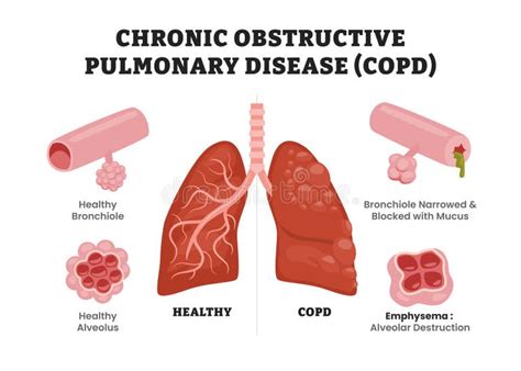 chronic obstructive pulmonary disease copd  healthy lungs