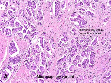 American Urological Association Urothelial Carcinoma Variants