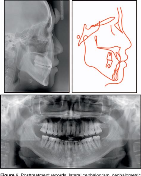 Figure 5 From Treatment Of Vertical Maxillary Excess Without Open Bite In A Skeletal Class Ii