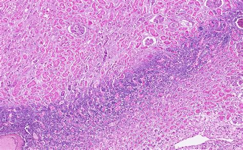 Slide 5 Kidney Acute Renal Infarct