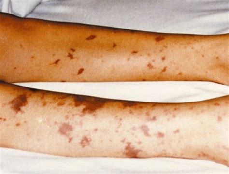 Meningitis Rash | Good Health