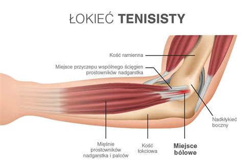 Łokieć tenisisty przyczyny objawy leczenie