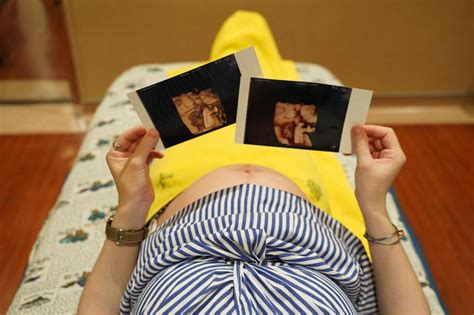 女嬰罹先天橫膈膜疝氣 高雄長庚在母胎階段就及時揪出 生活新聞 生活 聯合新聞網