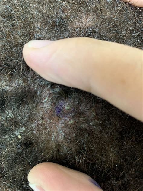 Pathology Outlines Eosinophilic Pustular Folliculitis Bacterial And