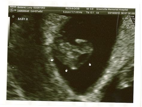 Boland Babies: 2nd ultrasound