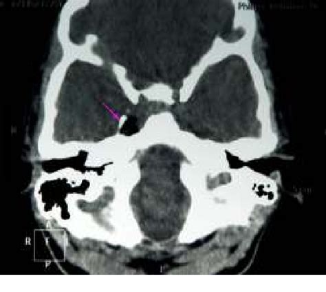 Facial Diplegia As A Clinical Presentation Of A Ruptured Intracranial