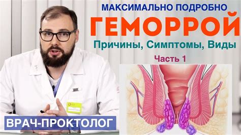 Геморрой - причины, симптомы, стадии и виды геморроя. - YouTube