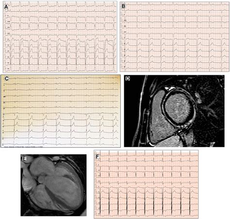 Conduction Disorders In Patients With Dcm Ecg Performed In A