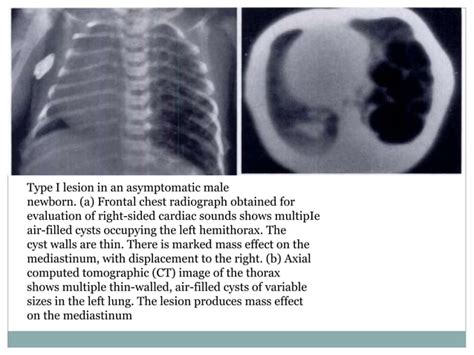 Congenital Cystic Adenomatoid Malformation Ppt