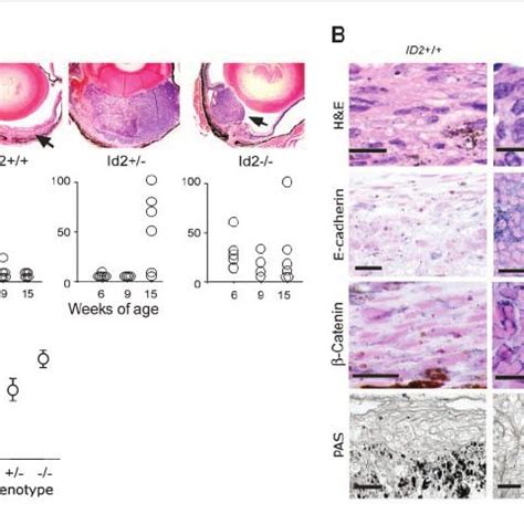 Id Inhibits Epithelial Differentiation In Uveal Melanoma Cells By