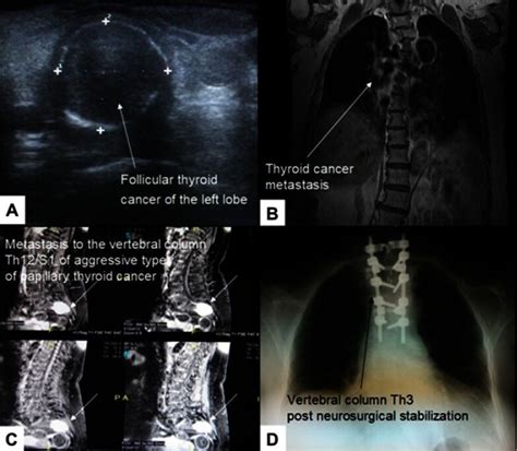 Thyroid Cancer Metastasis Papillary Thyroid Cancer Overview Symptoms