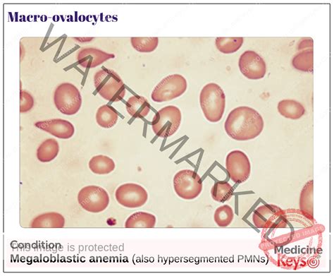 Macro-ovalocytes - Medicine Keys for MRCPs