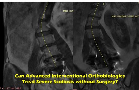 Scoliosis Treatment In Adultsscoliosis Treatment In Adults