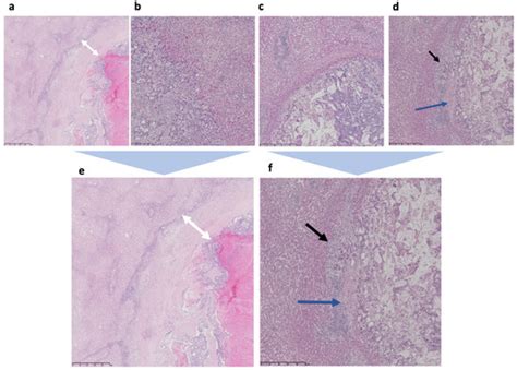 Cancers Free Full Text Histopathological Growth Pattern In