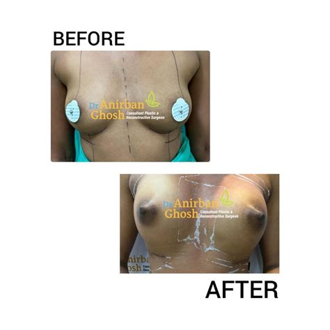 Before After Dr Anirban Ghosh Top Plastic Surgeon In Kolkata