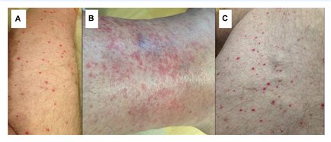 Figure 1 From Petechial Rash And Glomerulonephritis Semantic Scholar