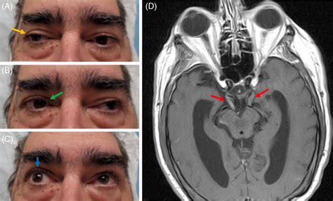 A Right Third Cranial Nerve Palsy With Resting Eye Position Down And Hot Sex Picture