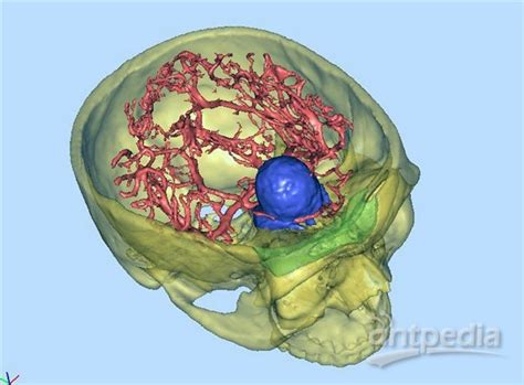 全球首例3d打印辅助颅底肿瘤切除术成功 分析行业新闻