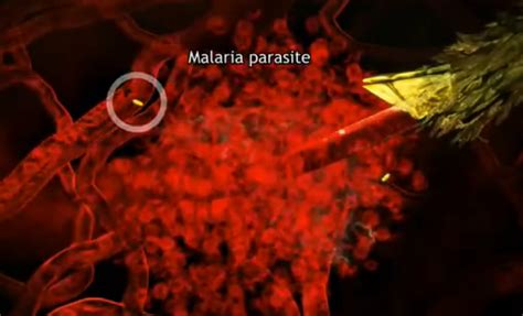 Malaria - Pictures, Parasite, Contagious, Causes, Treatment