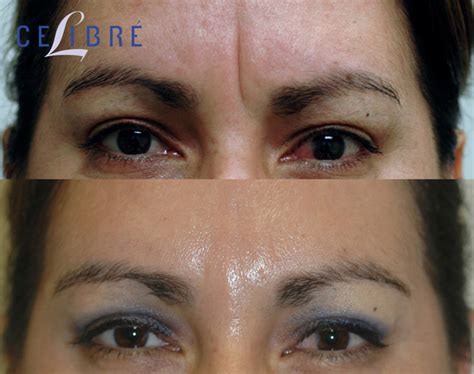 Botox Before And After Pictures Real Results From Real Patients