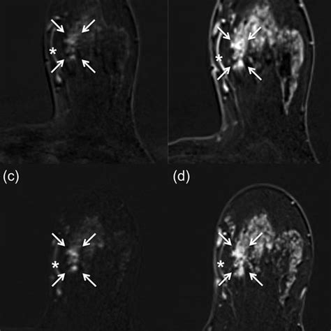 Invasive Breast Cancer In The Left Breast Of A 46 Year Old Woman Download Scientific Diagram