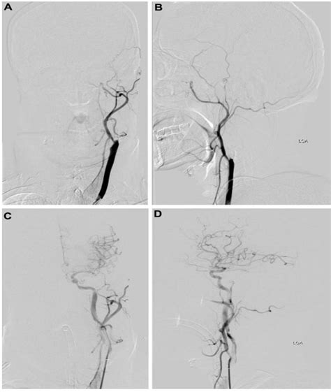 Preoperative Digital Subtraction Angiography DSA Showing Carotid