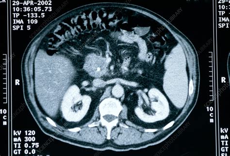 What Does Pancreatic Cancer Look Like On A Ct Scan What Does