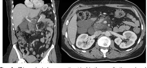 Figure 1 From Cystic Pancreatic Lymphangioma Diagnostic Role Of