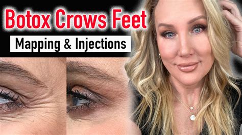 Botox Crows Feet Full Tutorial