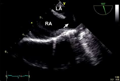 Modified Bicaval View Shows A Superior Sinus Venosus Atrial Septal